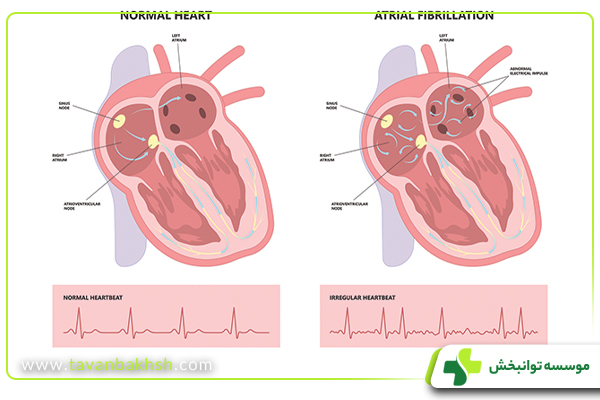 آشنایی با انواع جراحی قلب قرار دادن پیس میکر یا دفیبریلاتور کاردیوورتر قابل کاشت (ICD) 