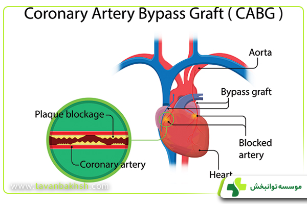 انواع عمل قلب پیوند عروق کرونر یا بای پس قلبی (CABG)