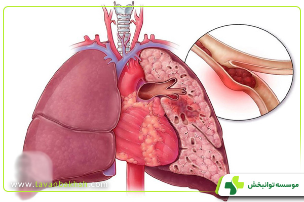 علائم امبولی ریه چیست