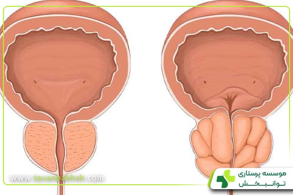 چه بیماری‌هایی باعث مشکلات پروستات می‌شود؟