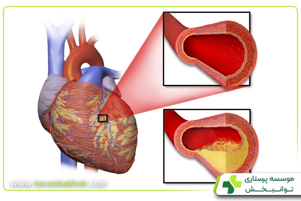 گرفتگی رگ‌های قلب