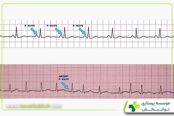 موج P در نوار قلب