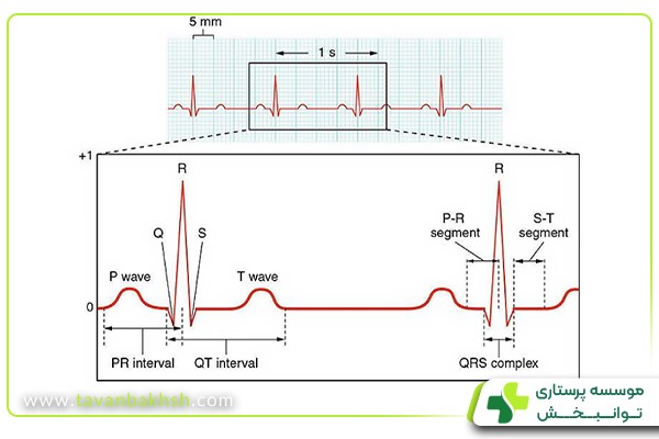 موج QRS در نوار قلب