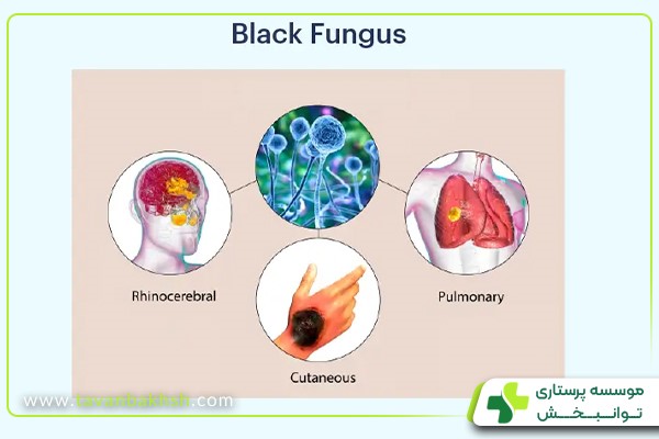 چه کسانی در معرض خطر ابتلا به قارچ سیاه هستند؟ 