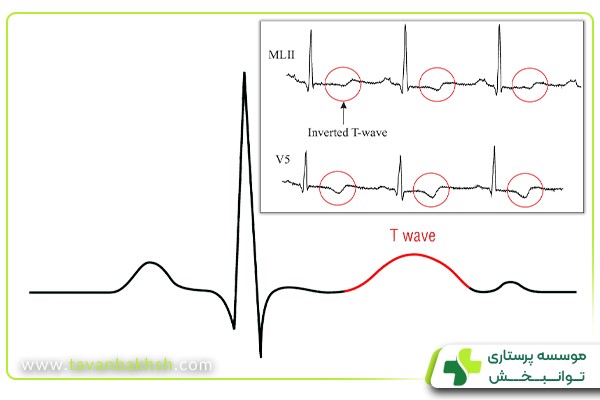 موج T در نوار قلب