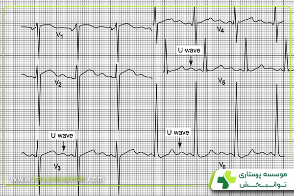 موج U در نوار قلب